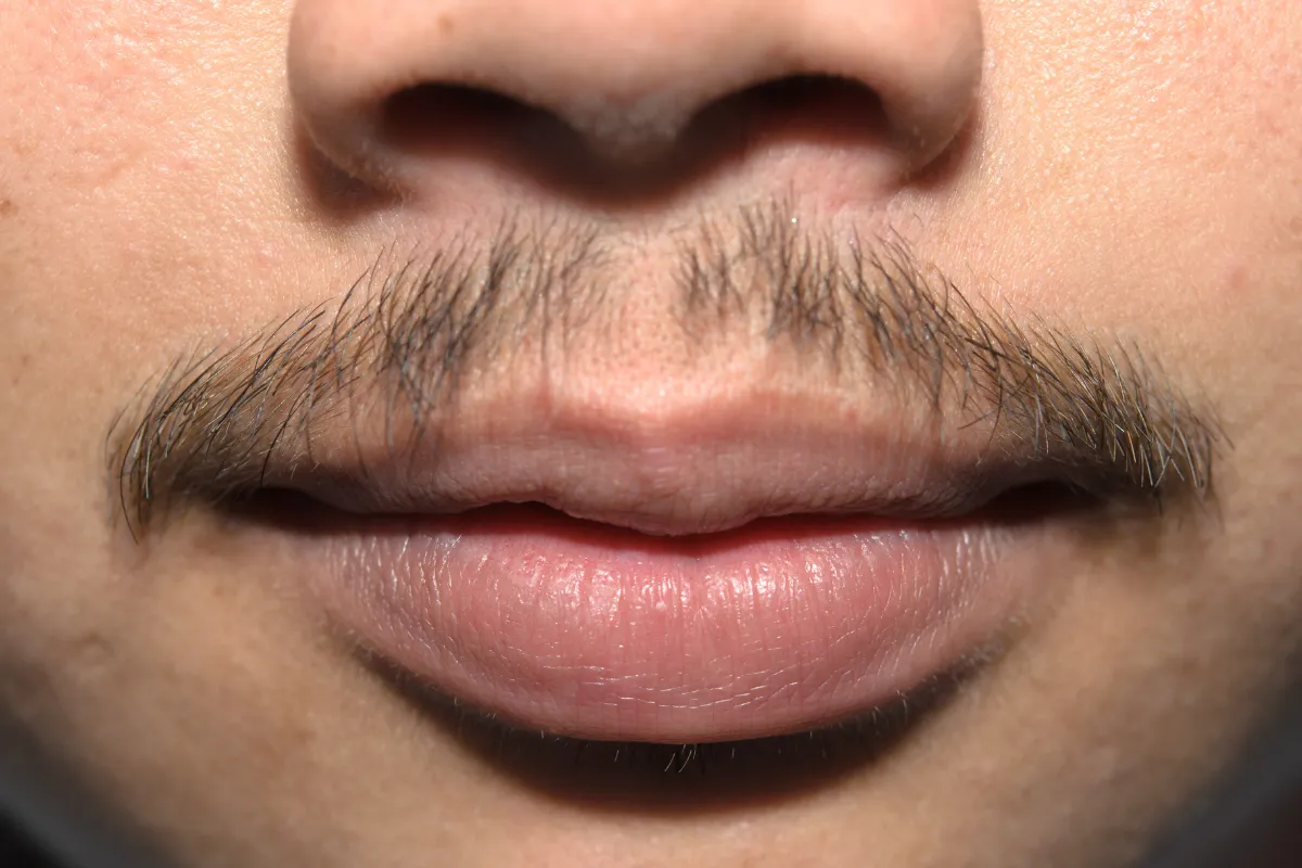 What Is a Mustache Transplant and What Should You Expect from the Procedure 2