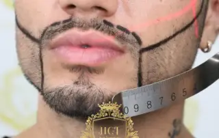 What Is a Mustache Transplant and What Should You Expect from the Procedure F