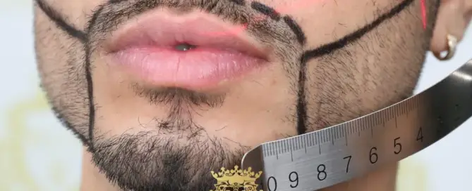 What Is a Mustache Transplant and What Should You Expect from the Procedure F