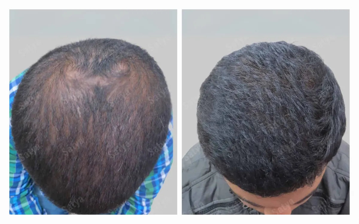 What are the results of PRP Hair Treatment 