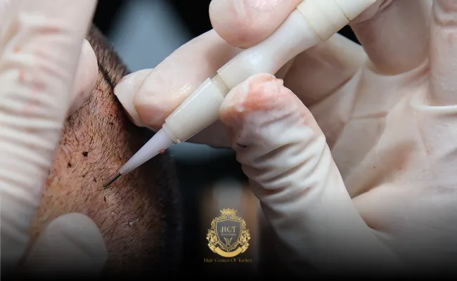 What is FUE DHI Hair Transplantation