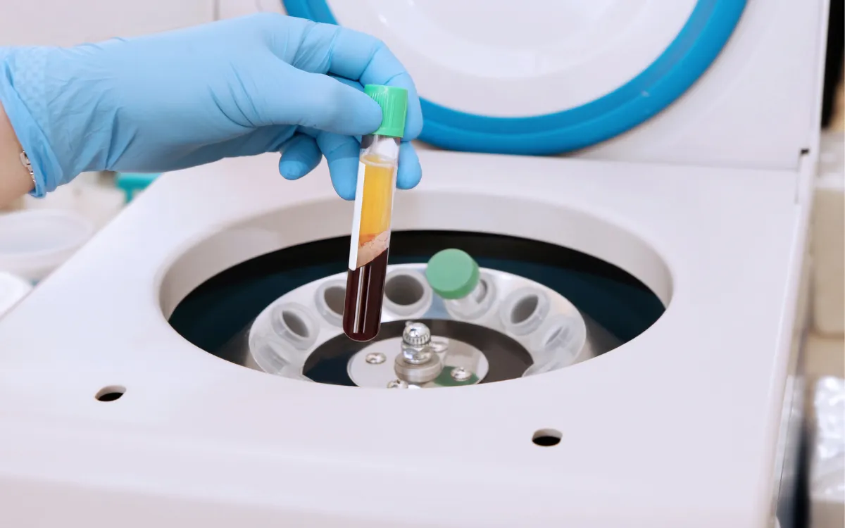 What is Platelet-Rich Plasma (PRP) hair treatment