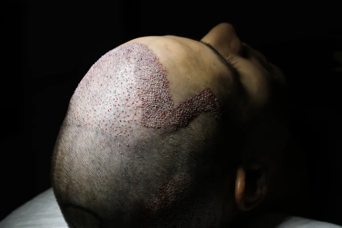 When Is It Safe to Have Sex After a Hair Transplant Surgery 3
