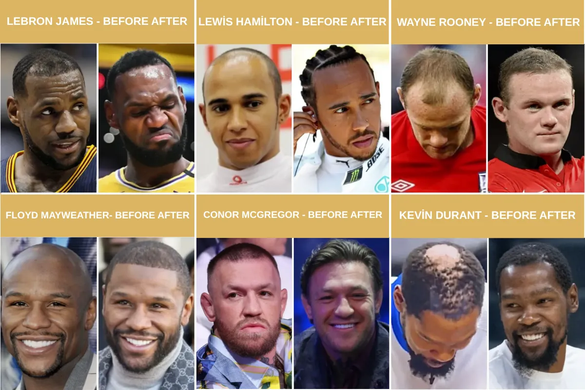 Which Celebrities Got Hair Transplants Famous Names Who Had Hair Restoration
