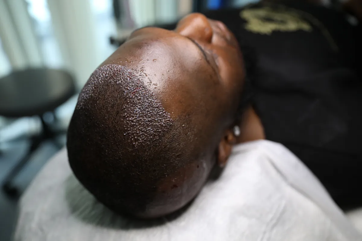 Which Type of Anesthesia Is Best for Hair Transplant Surgery 2