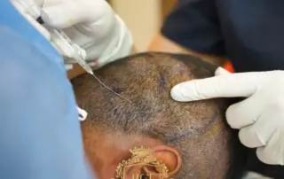 Which Type of Anesthesia Is Best for Hair Transplant Surgery f