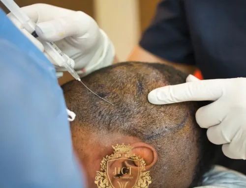 Welche Art der Anästhesie eignet sich am besten für eine Haartransplantation?