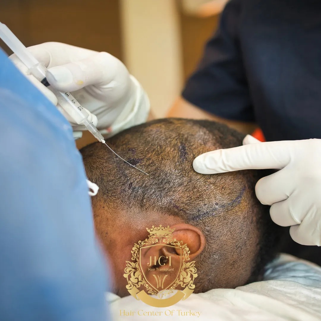 Which Type of Anesthesia Is Best for Hair Transplant Surgery f