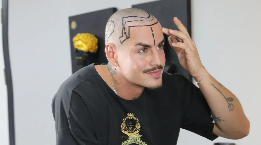 Who Should Get A DHI Hair Transplant?