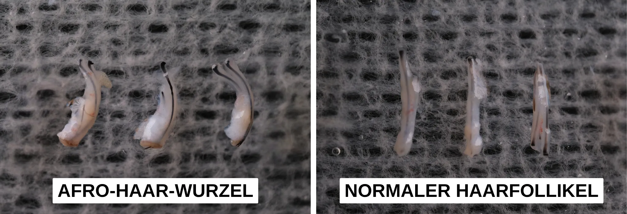 afro hair follicle vs normal hair follicle de afro hair follicle vs normal hair follicle