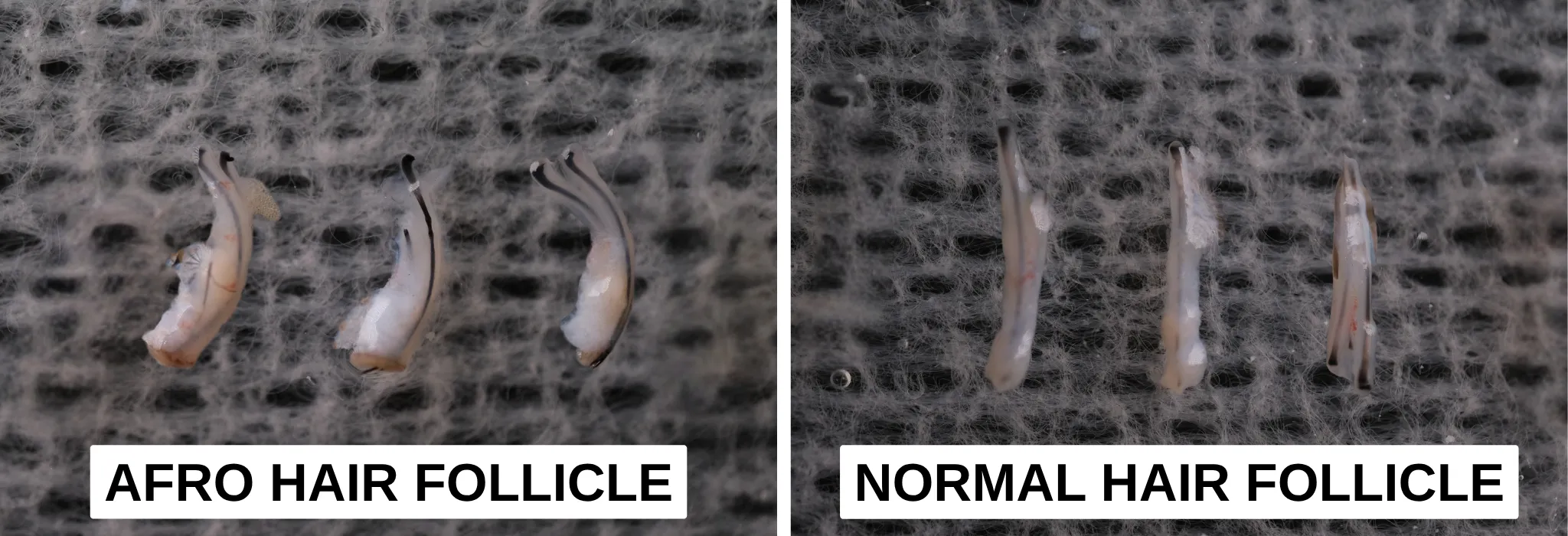afro hair follicle vs normal hair follicle