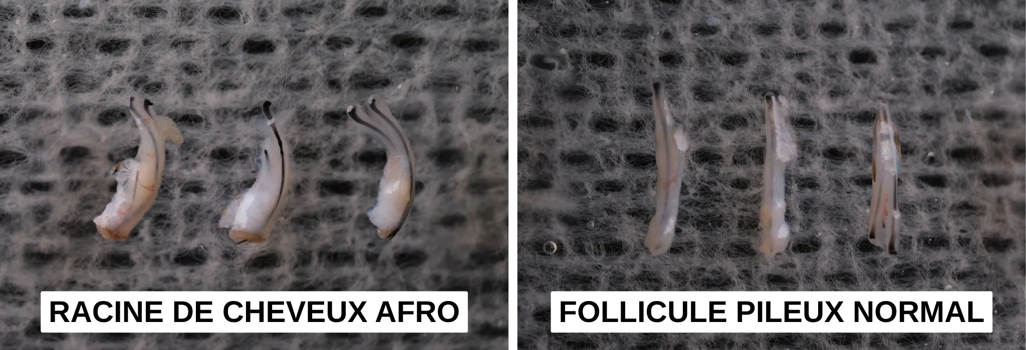afro hair follicle vs normal hair follicle