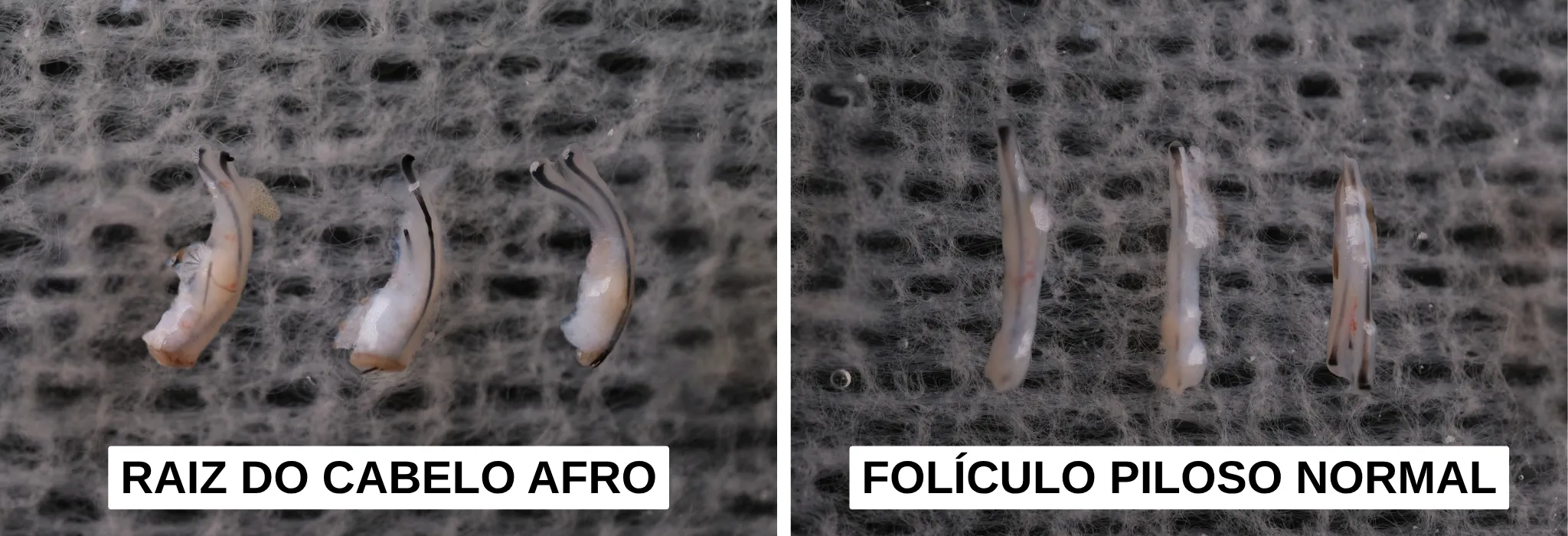 afro hair follicle vs normal hair follicle