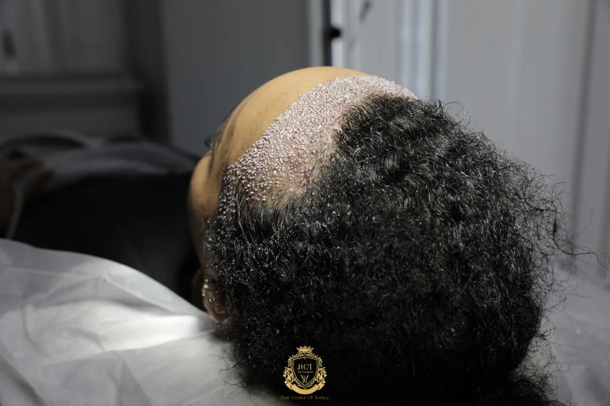 afro hair transplant for african american women