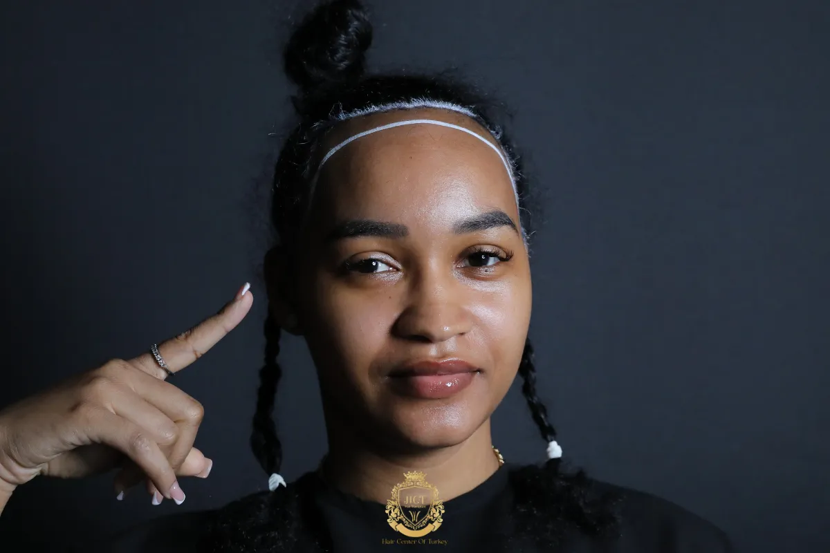 afro hair transplant for african american women