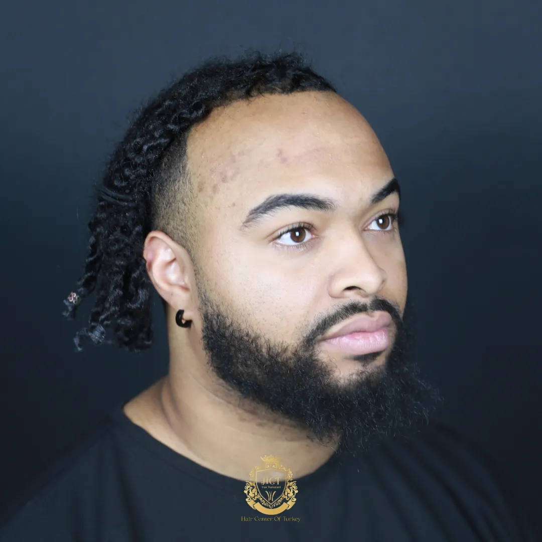 afro hair transplant results