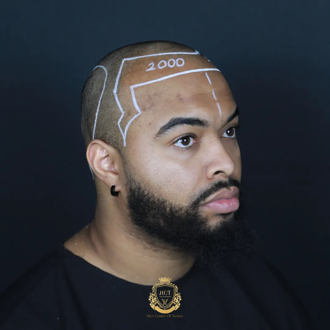 afro hair transplant results