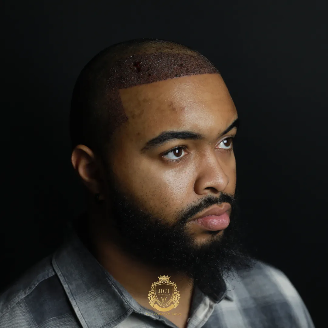 afro hair transplant results