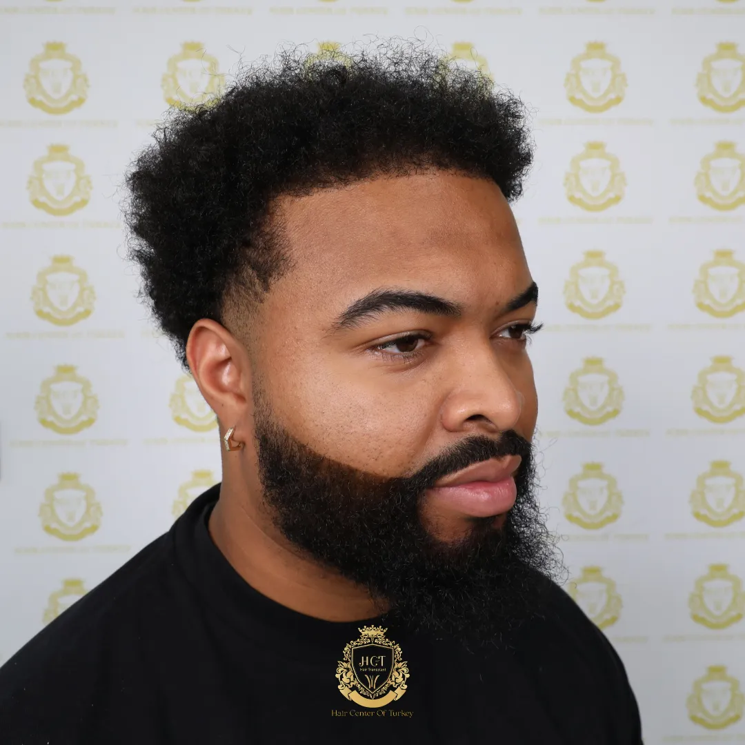 afro hair transplant results