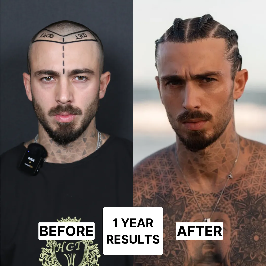 after sapphire fue hair transplant