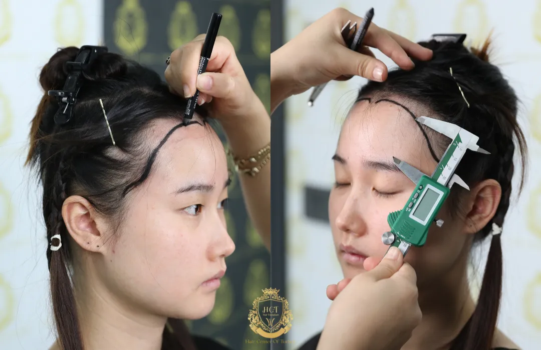 best hair transplant for women