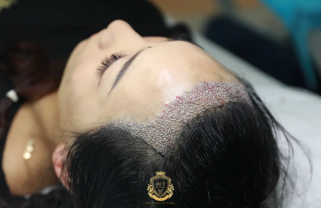 best hair transplant for women