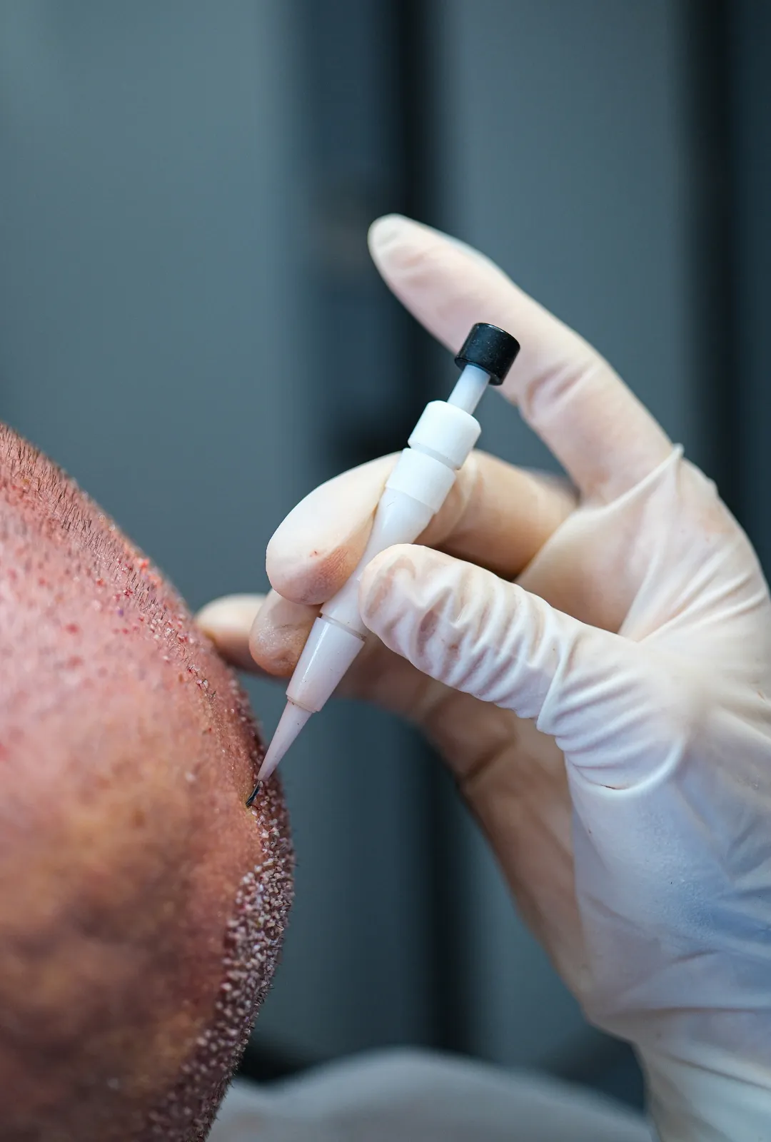 choi implantation pen dhi hair transplant