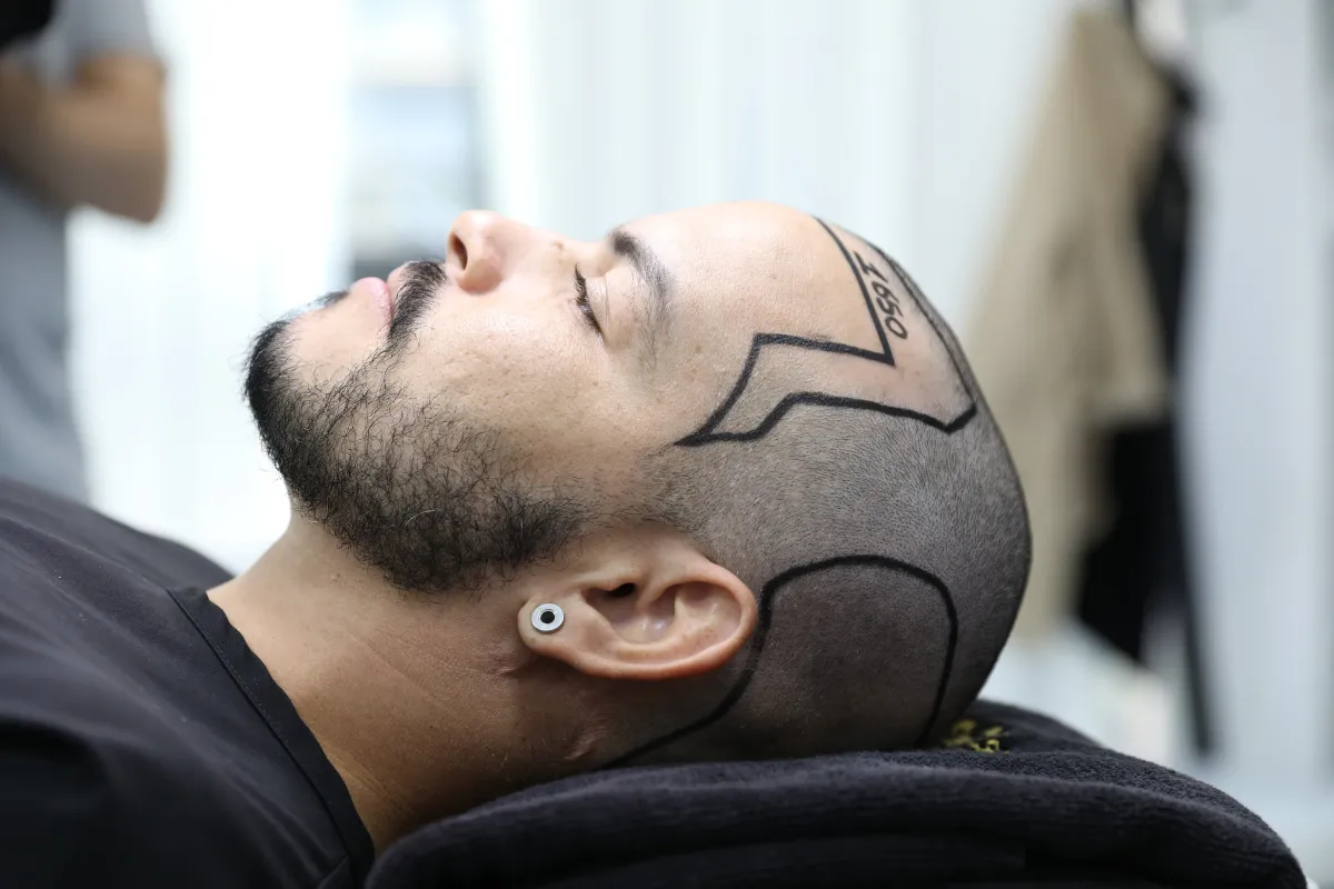 colestrole hair transplant