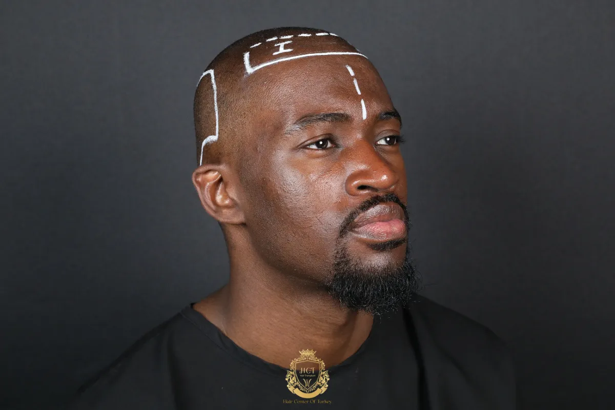 difference between afro hair transplant and hair transplant