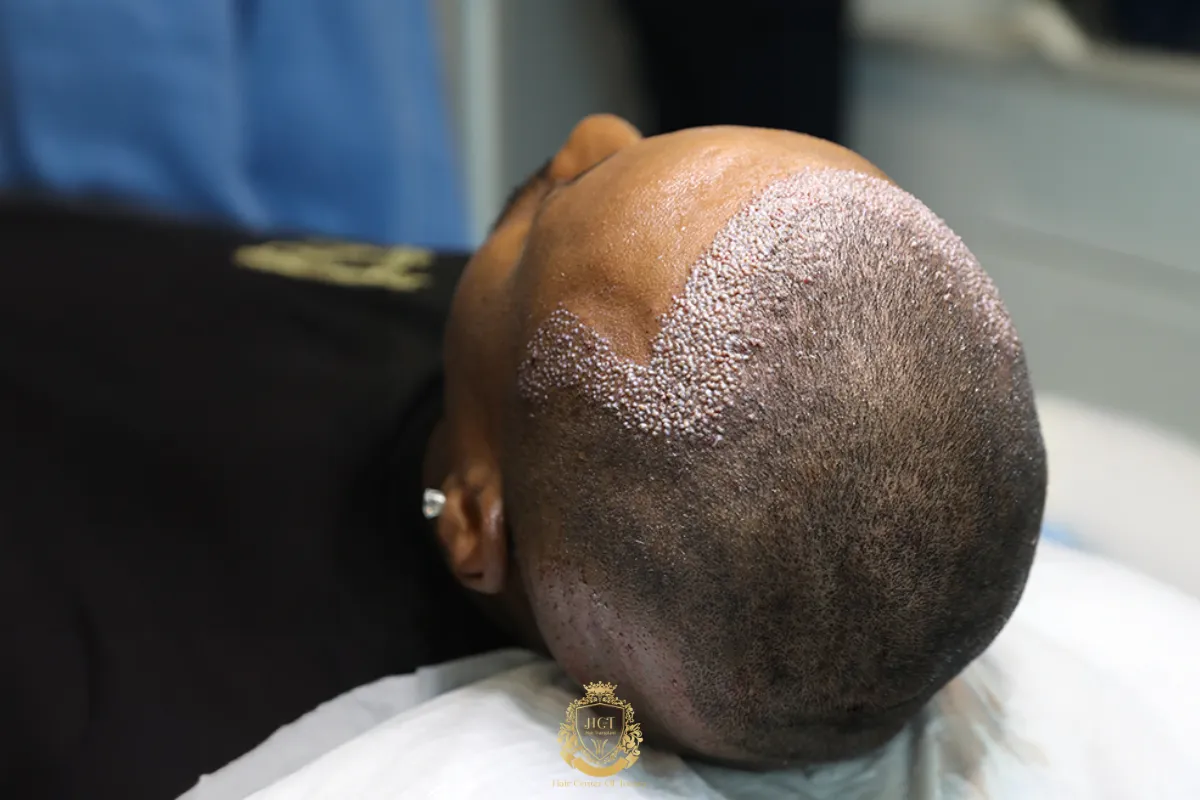 fue dhi afro hair transplant turkey