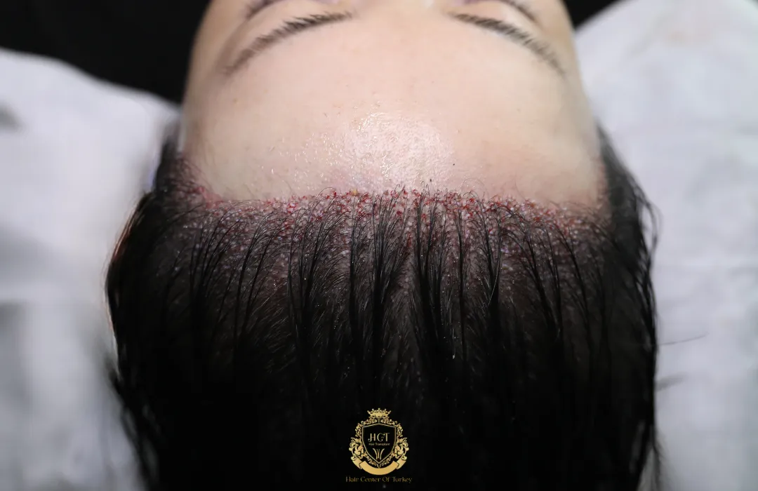 fue dhi female hair transplant