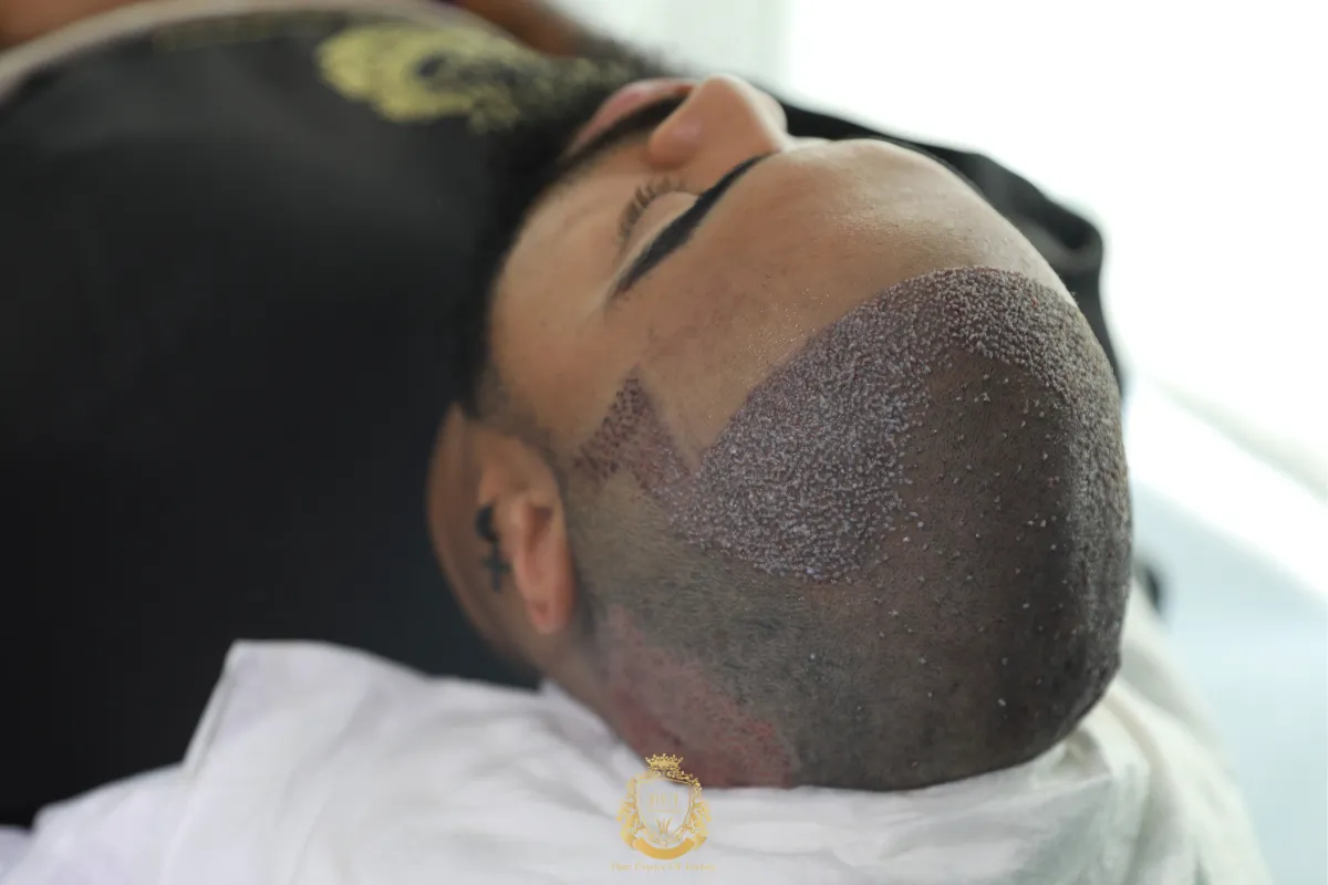 fue sapphire afro hair transplant turkey