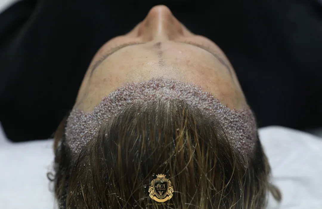 fue sapphire female hair transplant