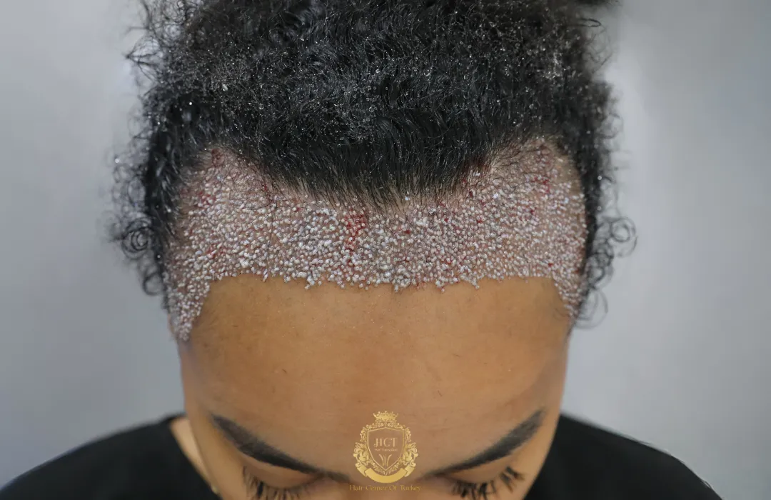 hair transplant for receding hairline women