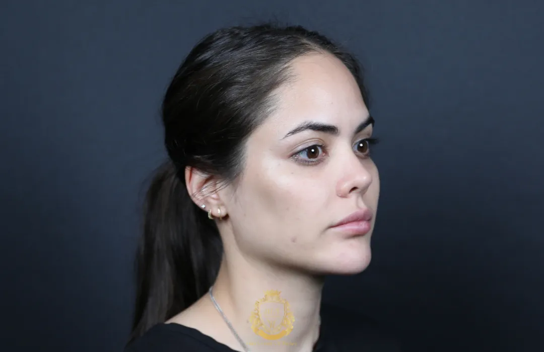 hair transplant for receding hairline women