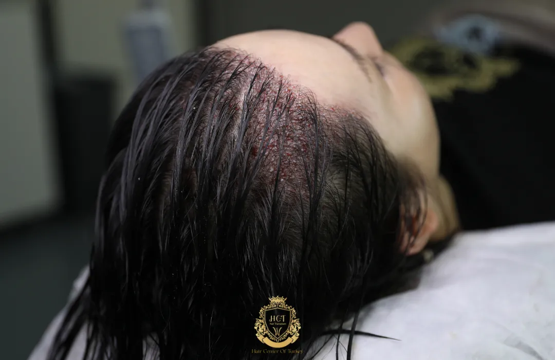hair transplant for thicker hair women