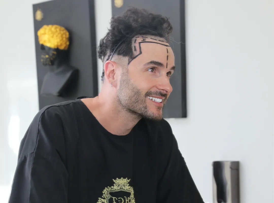 hair transplant without shaving