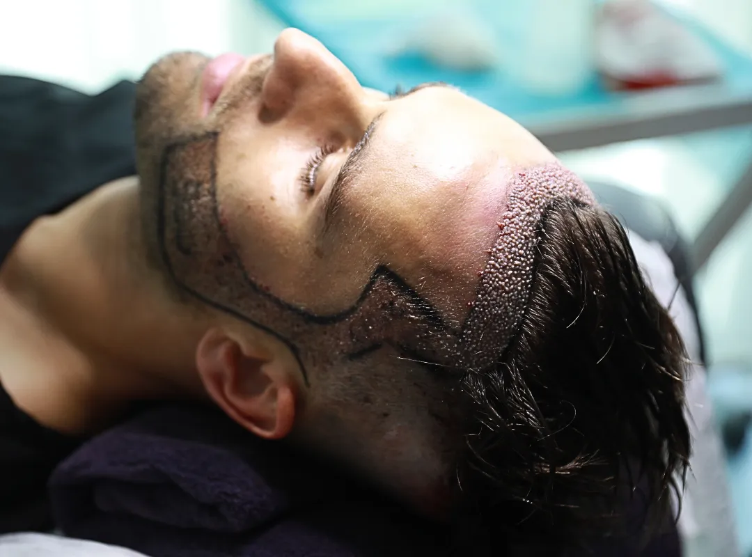 hair transplant without shaving
