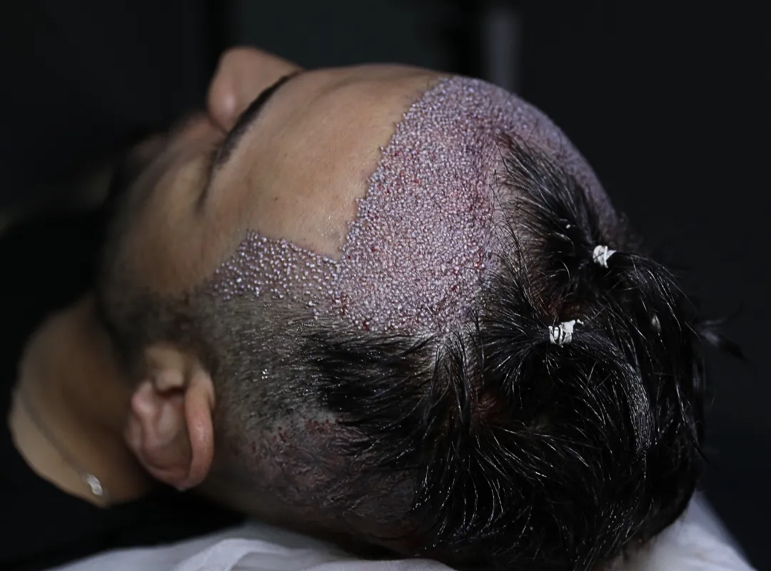 hair transplant without shaving
