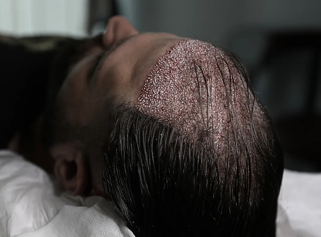 hair transplant without shaving