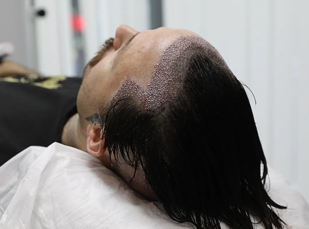 hair transplant without shaving