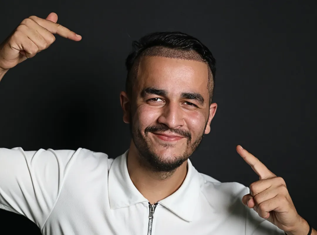 hair transplant without shaving
