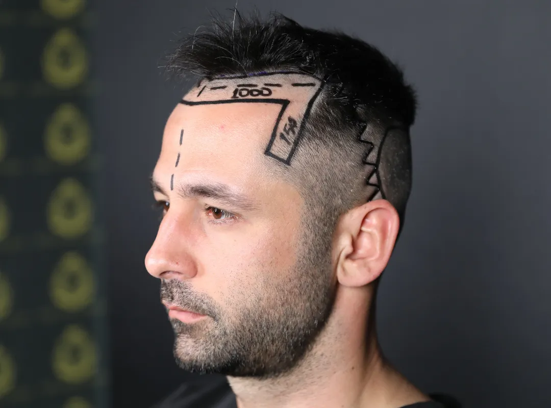 hair transplant without shaving