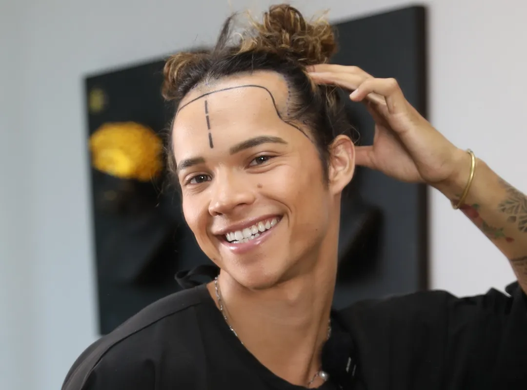hair transplant without shaving