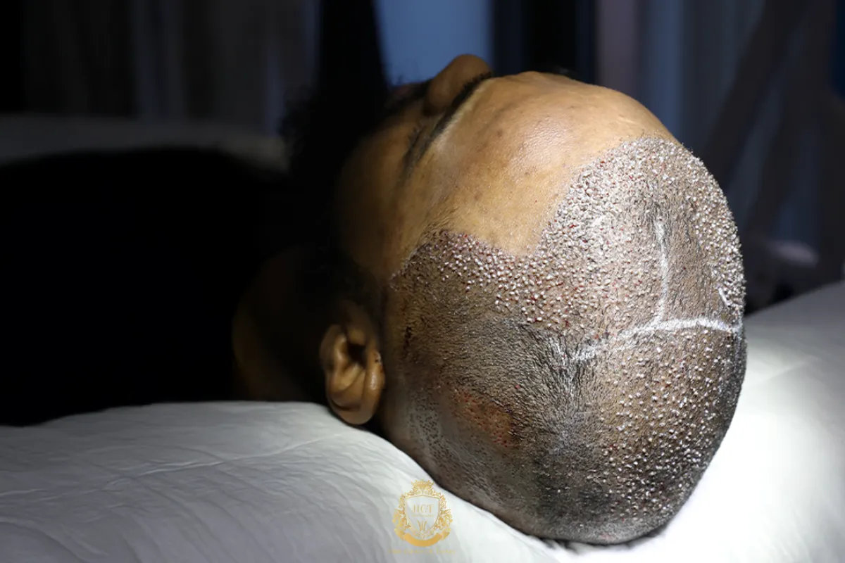 hybrid afro hair transplant turkey