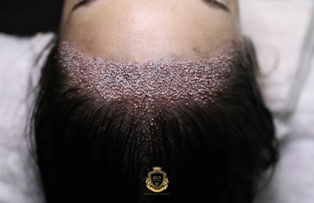 hybrid female hair transplant