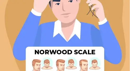 male pattern baldness and norwood scale
