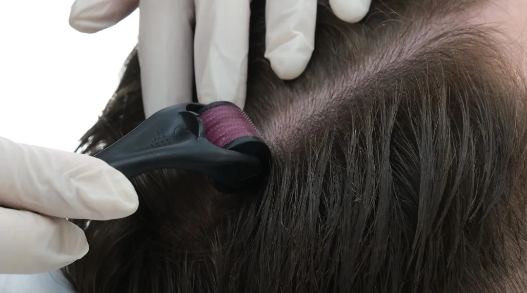 derma roller ile mezoterapi