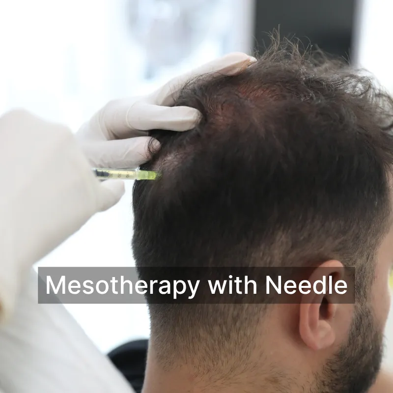 mezoterapiigneimg