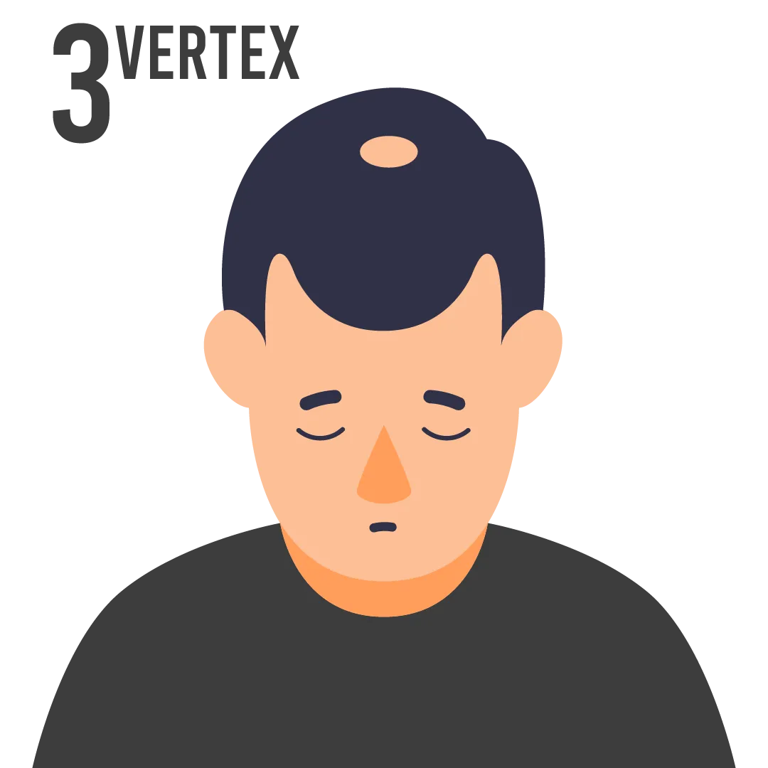 male pattern baldness norwood scale stage 3 vertex